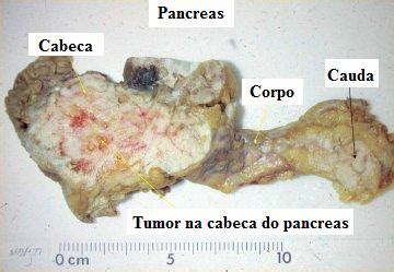 Liga de Patologia   UFC: Tumor de Pâncreas