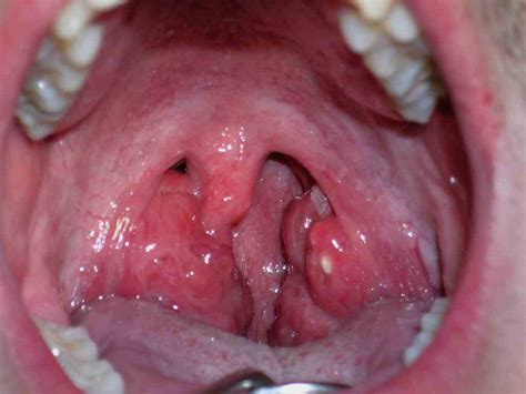 Linfoadenopatías | Patologia Oral, General, Bioestadística ...