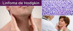 Linfoma de Hodgkin: Causas, Síntomas, Diagnóstico ...