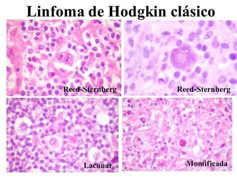 Linfoma de Hodgkin Representa el 30% de todos los linfomas ...