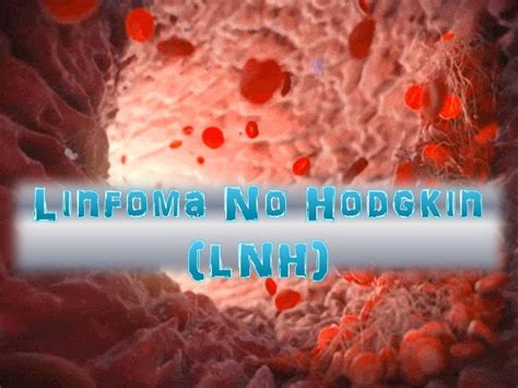 Linfoma No Hodgkin   YouTube