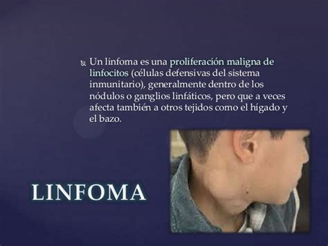 Linfoma Pediatría