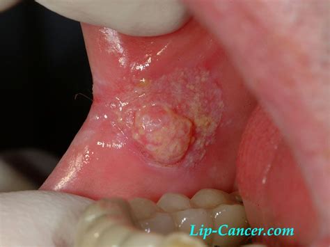 Lip Cancer Symptoms :: What are the symptoms of mouth ...