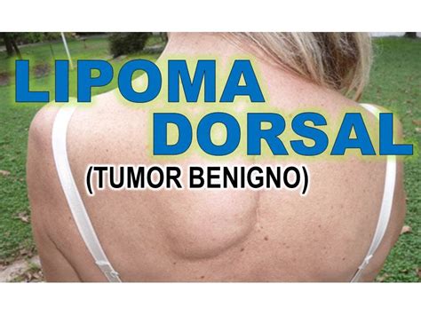 LIPOMA DORSAL   TUMOR BENIGNO SUBCUTANEO EN LA ESPALDA   YouTube