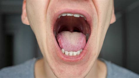¿Liquen plano oral dolorosas? Te contamos todo