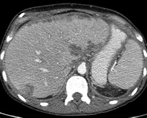 Liver Atlas: Case 137: Metastasis   Ovarian Cancer ...