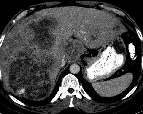 Liver Atlas: Case 36: Metastasis   Colorectal Cancer ...