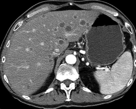 Liver Atlas: Diagnosis: Metastasis   Gallbladder Cancer