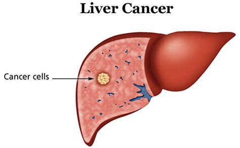 Liver Cancer   Causes, Symptoms, Diagnosis, Prognosis and ...