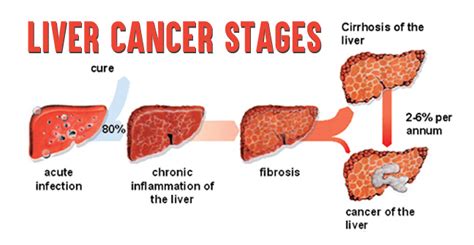 Liver Cancer Stages  How Stages of Lung Cancer are Determined!