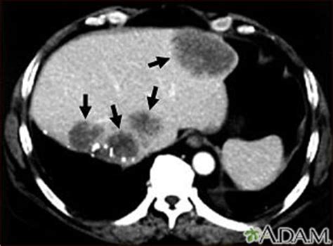 Liver metastases, CT scan: MedlinePlus Medical ...