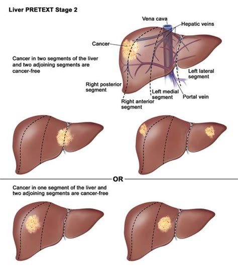 Liver Tumors in Infancy | IntechOpen