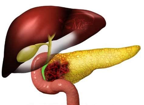 Living With Pancreatitis: Pancreatic Care at Home