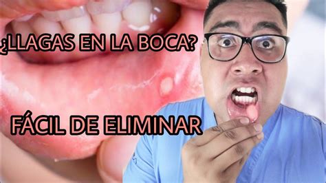 LLAGAS  AFTAS  EN LA BOCA ¿POR QUE SALEN?/¿COMO ELIMINARLAS? FÁCIL Y ...