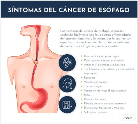 Lo que debes saber sobre el cáncer de esófago | Patologías ...