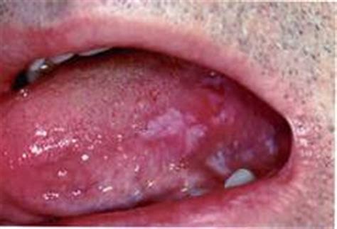 Logística Hospitalar e Saúde: Câncer de boca causado por ...