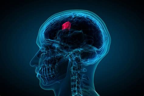 Los 20 tipos de tumores cerebrales  características y ...