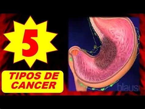 Los 5 tipos de cáncer más Comunes en México   YouTube