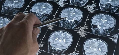Los sintomas de un tumor cerebral que usted debe reconocer