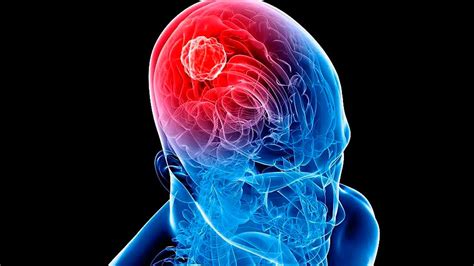 Los tumores cerebrales: tipos y síntomas principales
