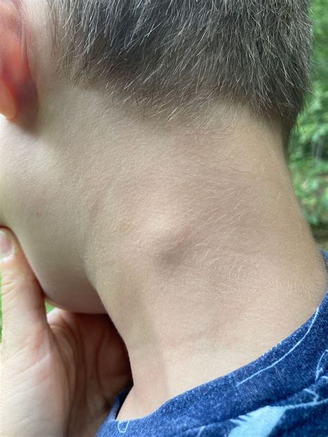 Lump on child’s neck | BabyCenter