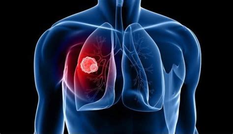 Lung cancer doesn’t only affect men or heavy smokers
