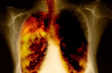 Lung Cancer Genes Identified   TIME