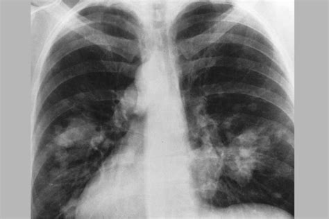 Lung cancer in non smokers on the rise: what does this ...