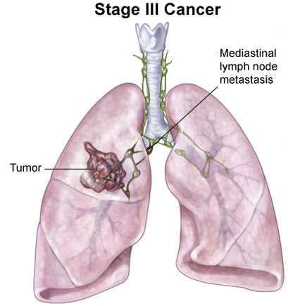 Lung Cancer   Stage 3 Lung Cancer | Kimaja Farwani.