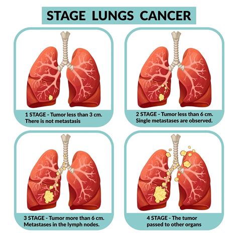 Lung Cancer: Symptoms, Treatment, Causes, Stages ...
