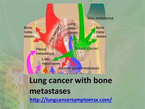 Lung cancer with bone metastases
