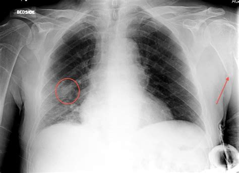 Lung cancer with bone metastasis   Radiology at St ...