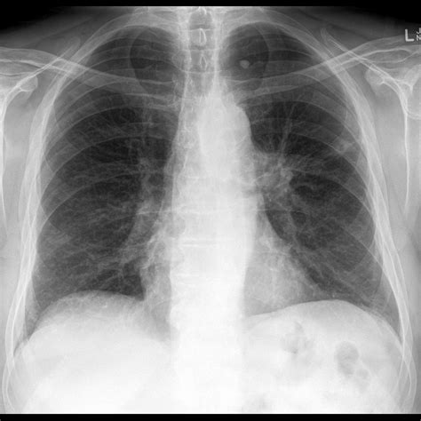 Lung cancer with nodal metastases | Image | Radiopaedia.org