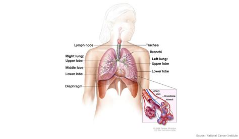 Lung Metastases   Diagnosis, Prognosis & Treatment