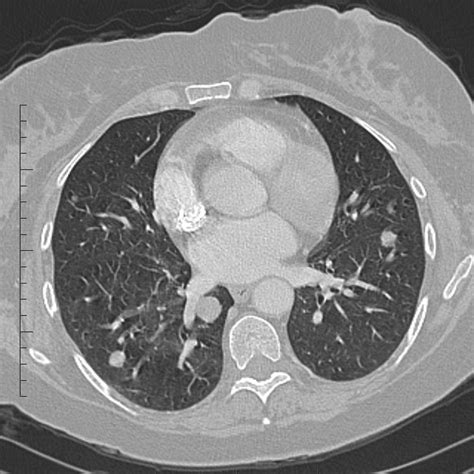 Lung metastases from colorectal cancer | Image ...