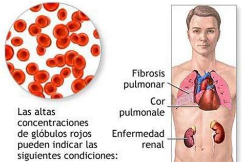 LUPUS Y AMIGOS: Fibrosis pulmonar, incurable, pero se ...