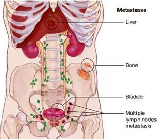Lymph Nodes and Prostate Cancer