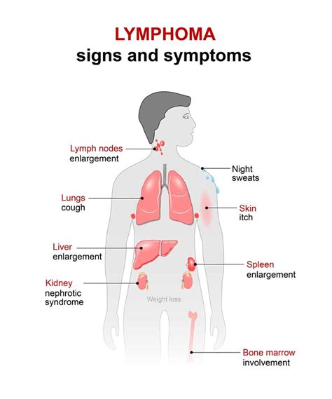 Lymphoma Symptoms; 9 Warning Signs of Lymphoma | Page 9 of ...