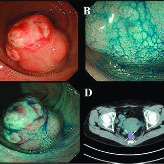 Macroscopic findings of the rectal tumor. 2A & 2B show the ...