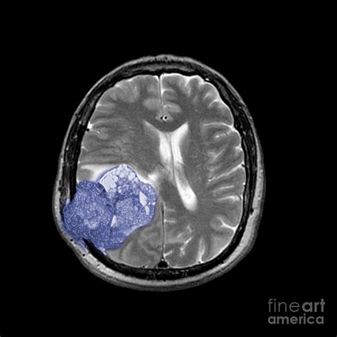 Malignant Brain Tumor, 1 Of 3 Photograph by Living Art ...