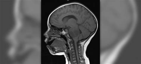 Malignant brain tumor | General center | SteadyHealth.com
