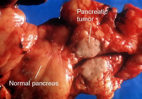 Malignant: Malignant Tumor On Pancreas