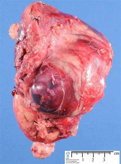 malignant rhabdoid tumor   Humpath.com   Human pathology