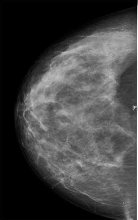 Mamografía | Dexeus Mujer