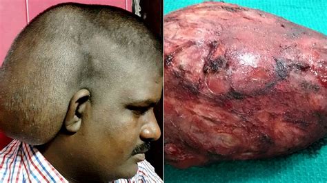 Man let massive head tumor grow for 20 years over alleged ...