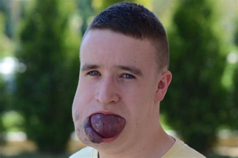 Man with massive tongue tumor in desperate need of life ...
