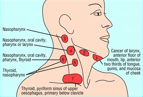 Management of lateral neck masses in adults | The BMJ