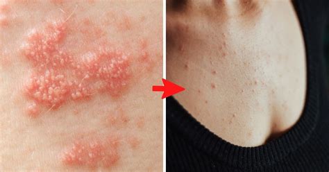¿Manchas rosadas en la piel Esta es la enfermedad que las causa | Salud180