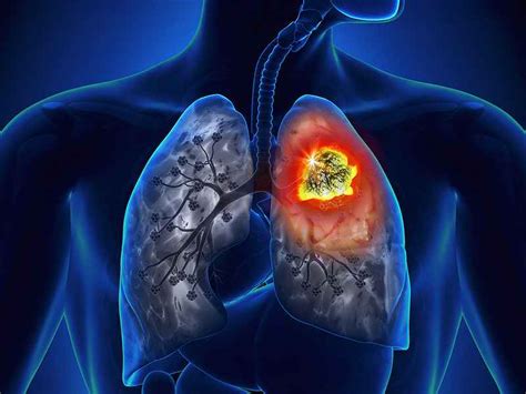 MarketResearchFuture: Lung Cancer Market Innovation by ...