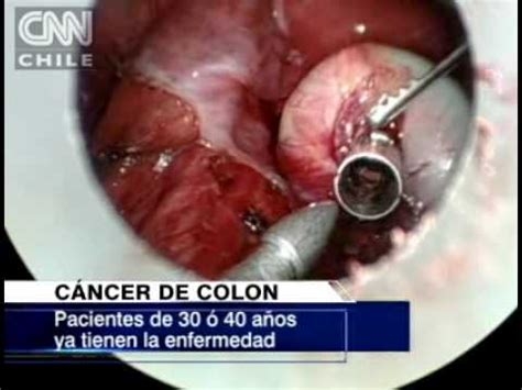 Más de mil personas mueren al año por cáncer de colon ...